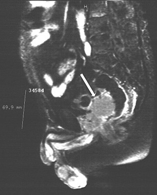 Chimiothérapie Adjuvante Définition