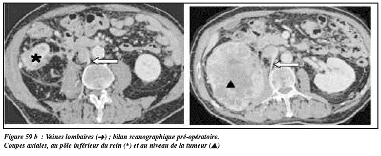 Most cancers Du Rein Inopérable