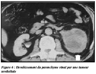 Tumeur Urotheliale De Haut Grade