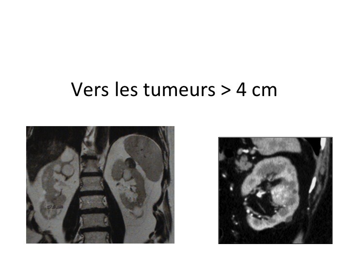 urofrance-pour-ou-contre-3-elargir-les-indications-des-traitements