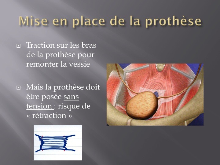 Urofrance | Prolapsus stade 3 par voie basse - Urofrance