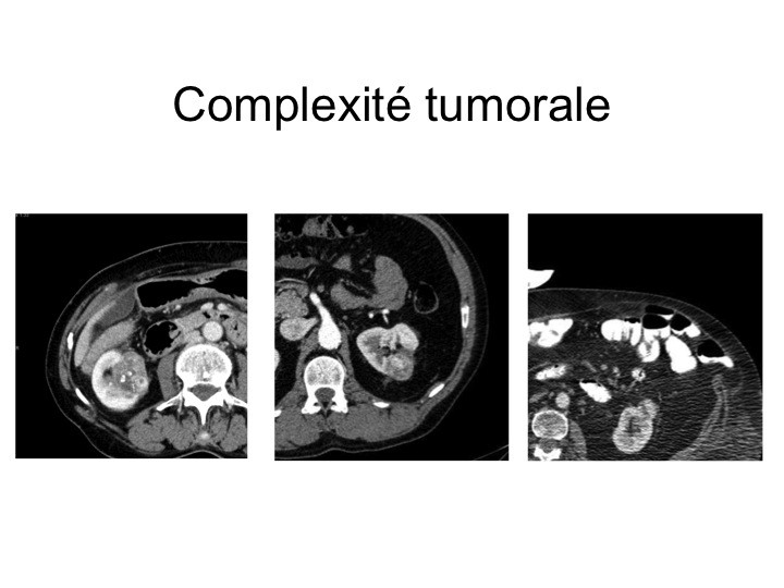 Urofrance Comment gérer les complications de la néphrectomie — free download