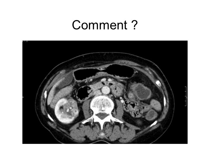 Urofrance Comment gérer les complications de la néphrectomie — free download