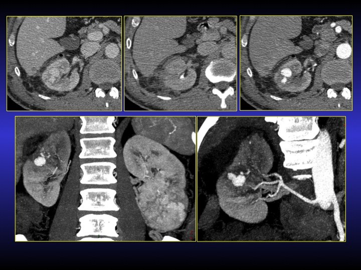 Urofrance Comment gérer les complications de la néphrectomie — free download
