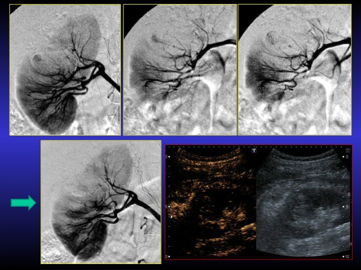 Urofrance Comment gérer les complications de la néphrectomie — free download