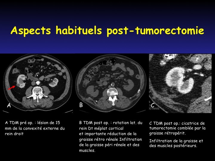 Urofrance Comment gérer les complications de la néphrectomie — free download