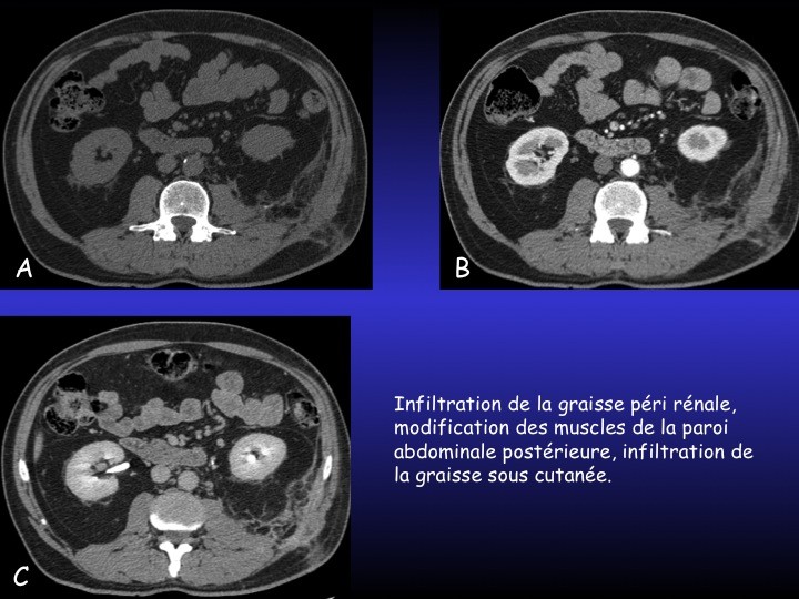 Urofrance Comment gérer les complications de la néphrectomie — free download