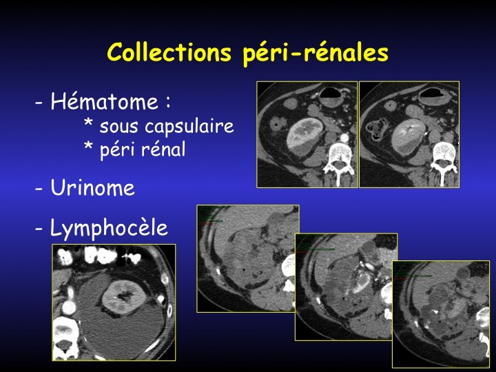 Urofrance Comment gérer les complications de la néphrectomie — free download