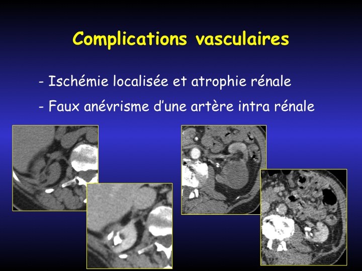 Urofrance Comment gérer les complications de la néphrectomie — free download