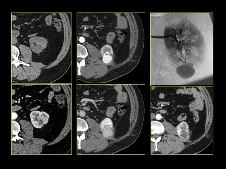 Urofrance Comment gérer les complications de la néphrectomie — free download