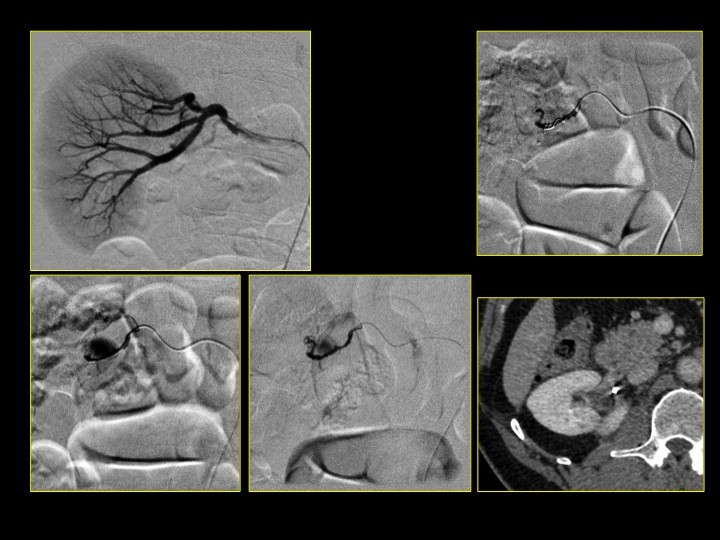 Urofrance Comment gérer les complications de la néphrectomie — free download
