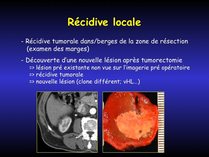 Urofrance Comment gérer les complications de la néphrectomie — free download