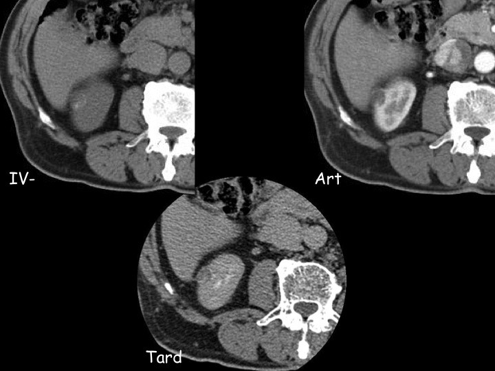 Urofrance Comment gérer les complications de la néphrectomie — free download