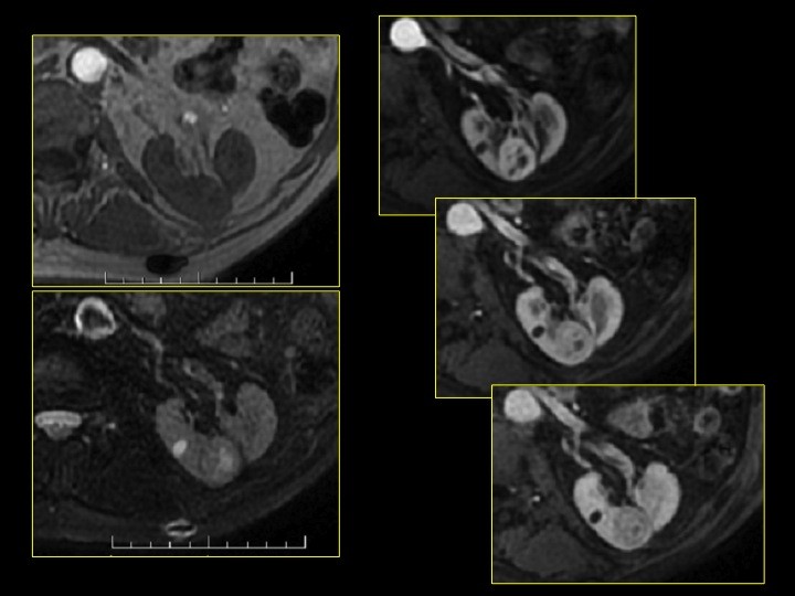 Urofrance Comment gérer les complications de la néphrectomie — free download