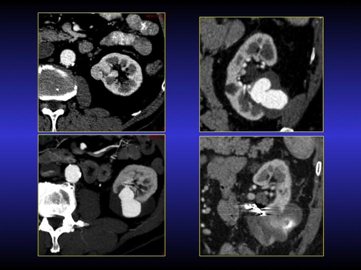Urofrance Comment gérer les complications de la néphrectomie — free download