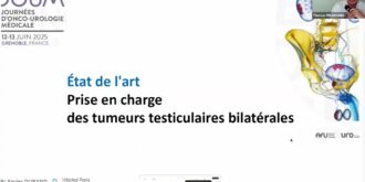 Prise en charge des tumeurs testiculaires bilatérales, synchrones ou non synchrones.